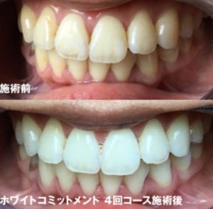 ホワイトニングBA2